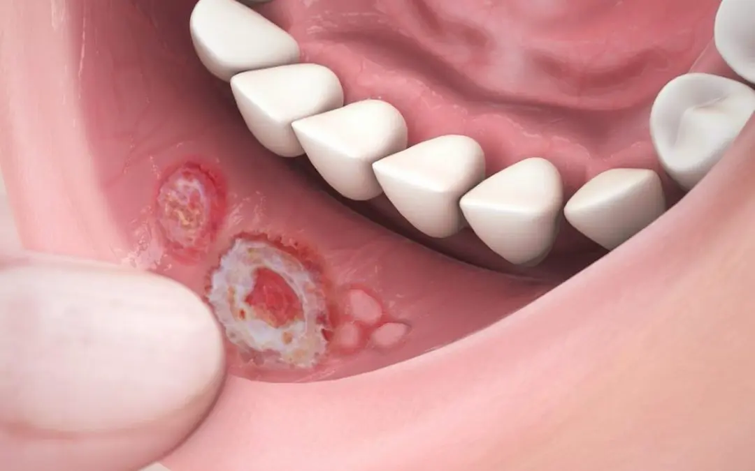 llagas en la boca por gastritis - Cómo curar una llaga en la boca del estómago