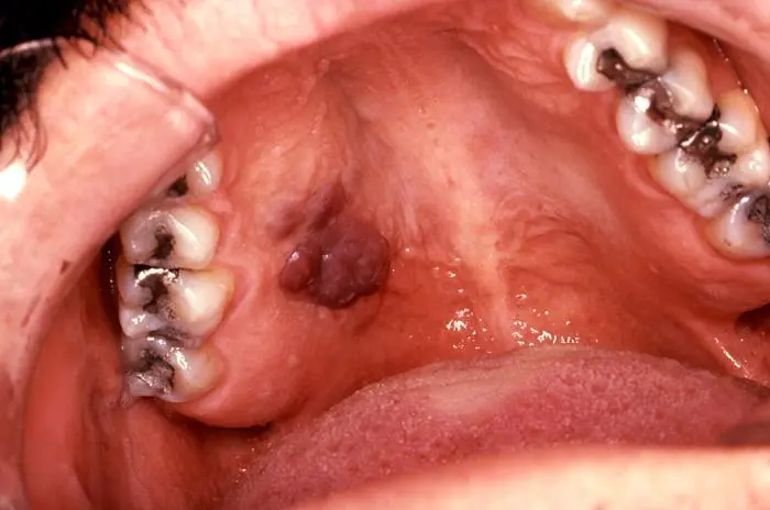 sarcomas en la boca - Cómo empieza el sarcoma de Kaposi en la boca
