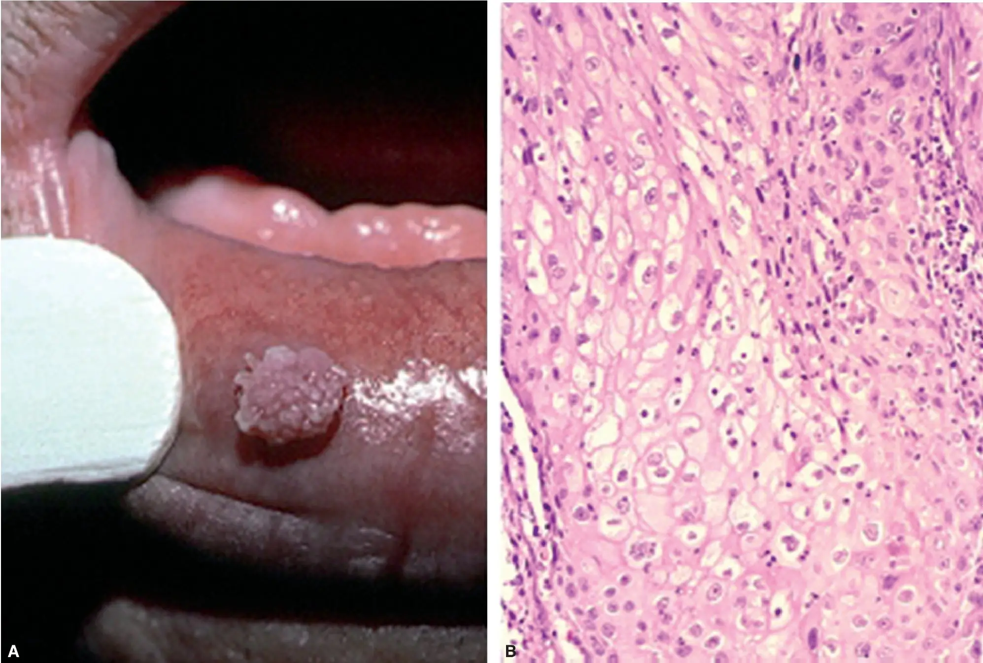 tumor en la boca - Cómo es un tumor benigno en la boca