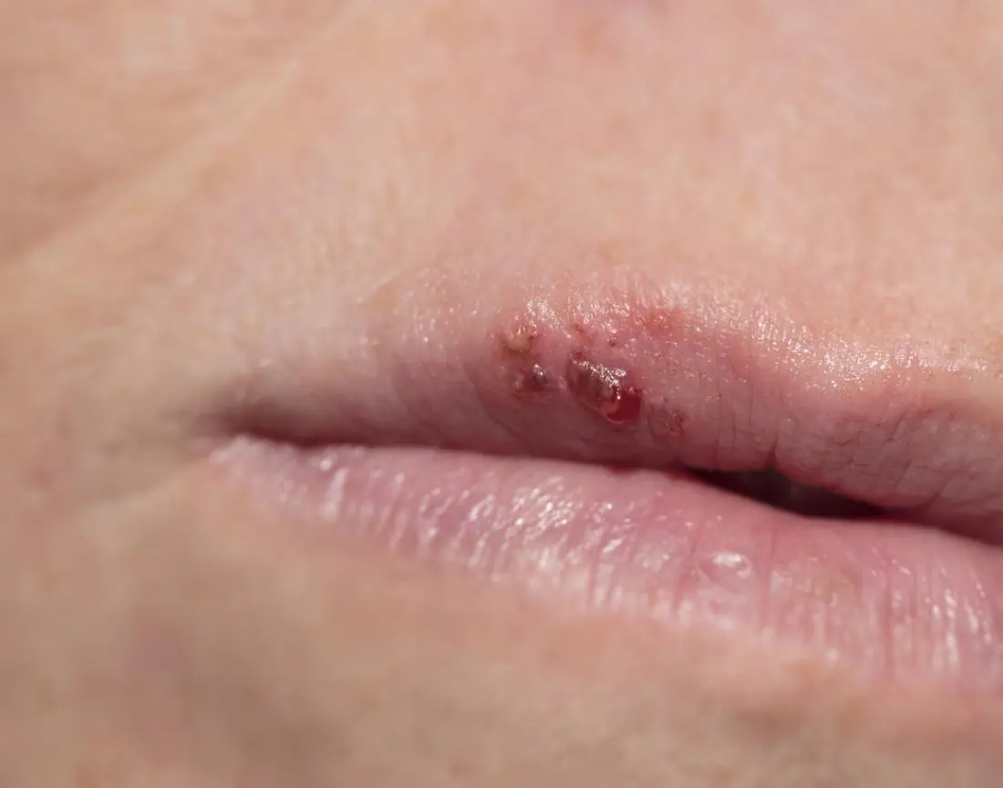 herpes en la boca como empieza - Cómo me doy cuenta de que tengo herpes