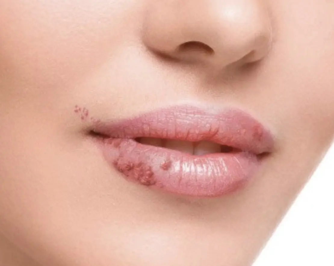 comezon en los labios boca - Cómo quitar la comezón de los labios