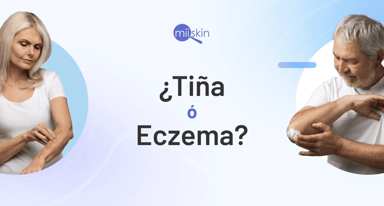 dermatitis atopica en boca - Cómo saber si es hongo o dermatitis