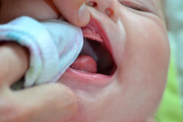como usar nistatina na boca - Cómo se pone la nistatina en tabletas vagniales