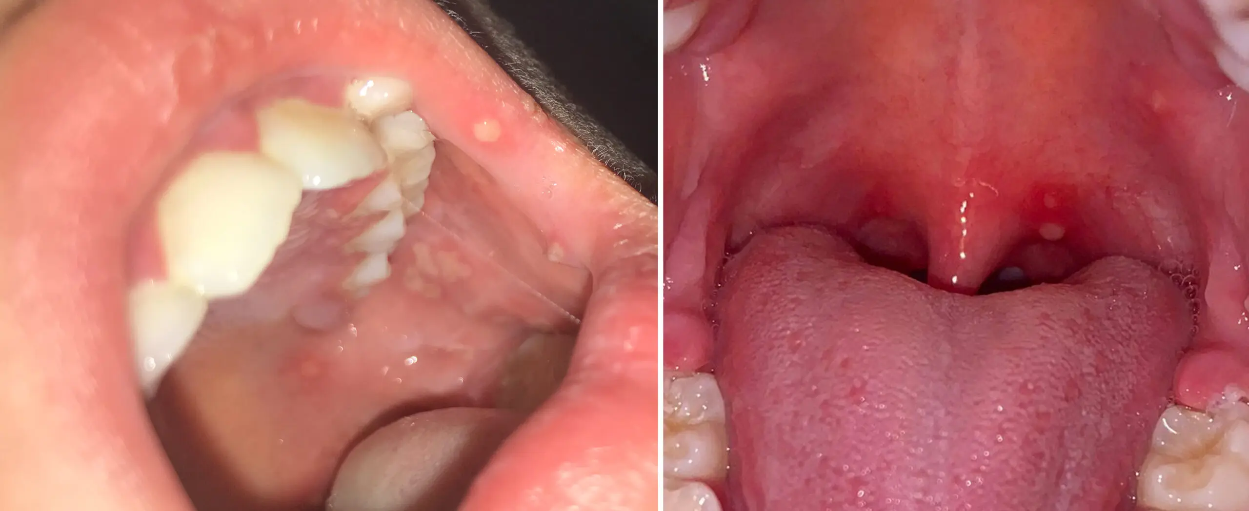 Llagas en la boca y coronavirus: síntomas, diagnóstico y tratamiento - Cómo se ve la lengua si tienes covid llagas en la boca coronavirus - Cómo se ve la lengua si tienes covid