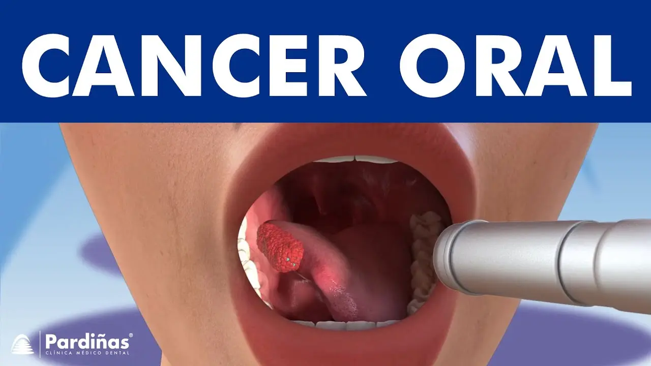 carne crecida en la boca - Cómo se ve un fibroma en la boca