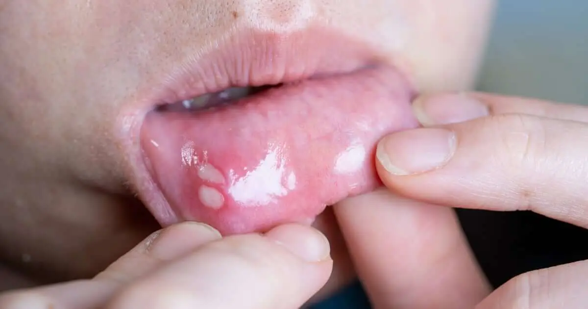 Llagas con pus en la boca: causas, tratamientos y prevención | A Que ...