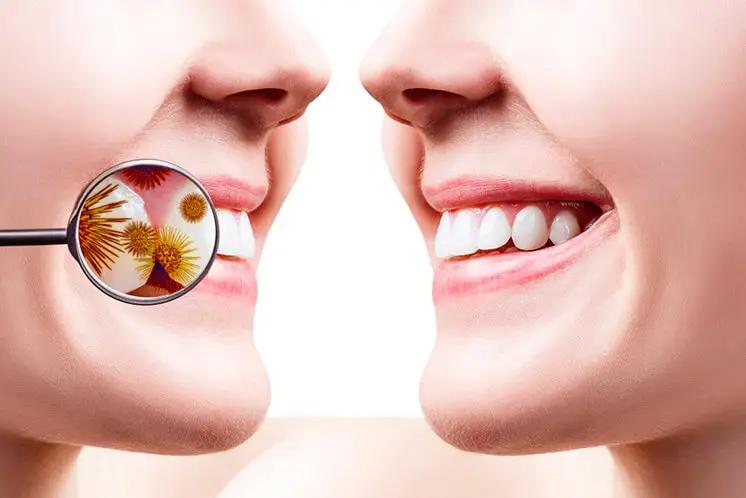 bacterias en la boca - Cuáles son las bacterias dañinas en la boca