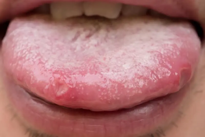llagas en la boca por gastritis - Cuando tienes gastritis te salen llagas en la boca.