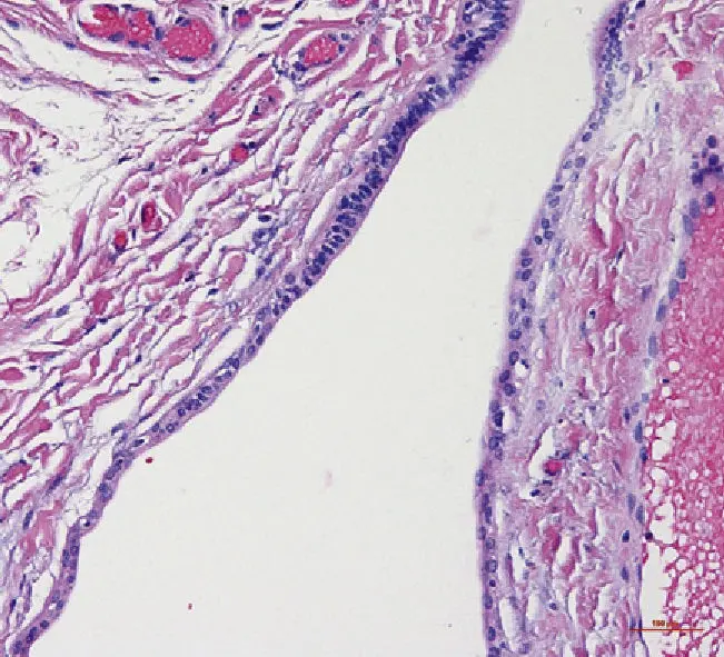 tumor de celulas gigantes boca - Por qué salen tumores benignos en la boca