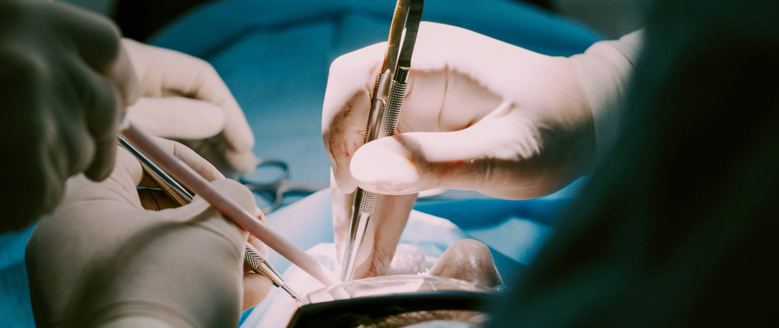 epulis boca - Qué causa el épulis gingival