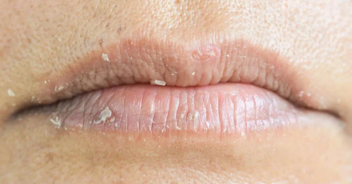 crema para hongos en los labios dela boca - Qué crema es buena para los hongos en la boca