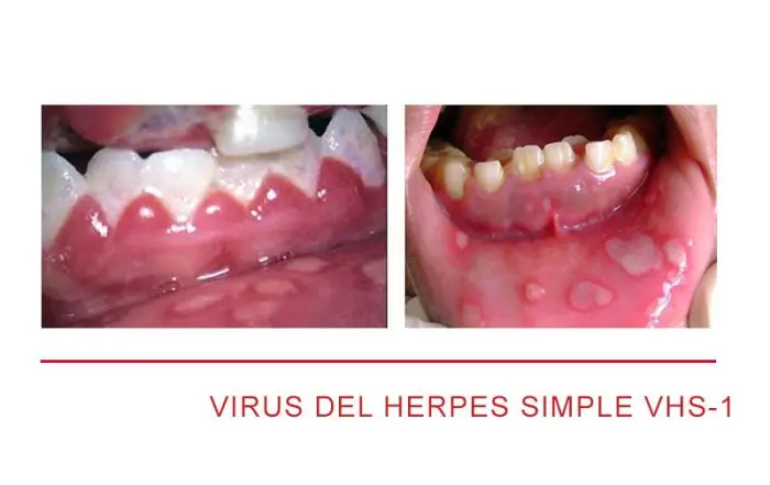 herpes simplex en la boca - Qué despierta el virus del herpes labial
