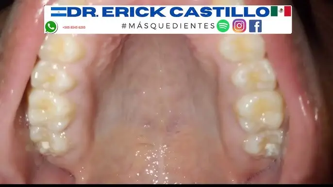 cielo de la boca blanco - Qué enfermedades afectan al paladar