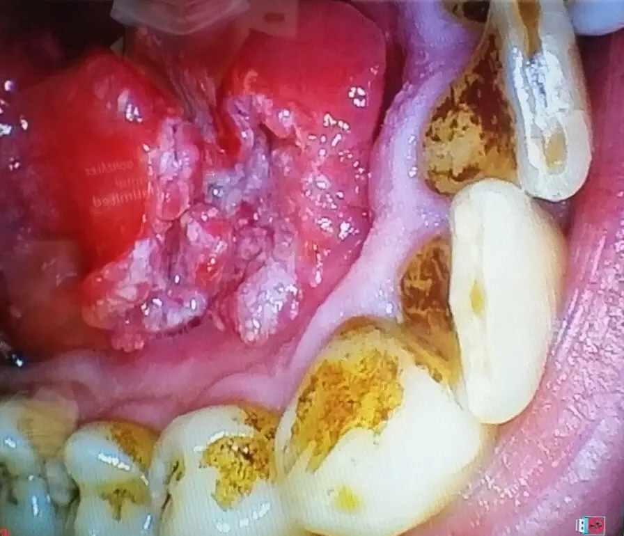 neoplasia en la boca - Qué es la neoplasia en odontología