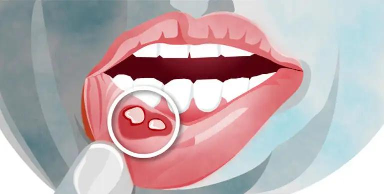 llagas en la boca ganglios inflamados - Qué infecciones hacen inflamar los ganglios