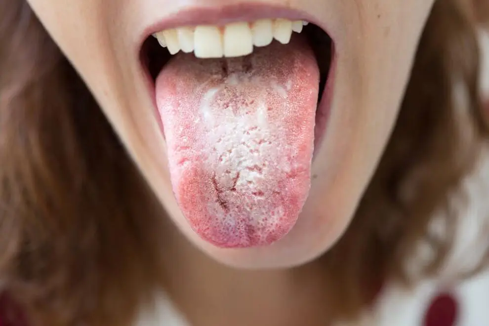 medicamento hongos boca - Qué jarabe es bueno para los hongos de la boca