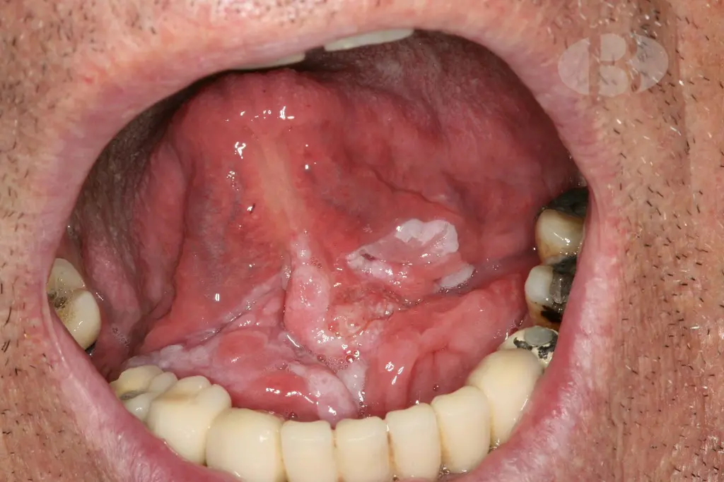 neoplasia en la boca - Qué neoplasia maligna es más frecuente en la cavidad oral