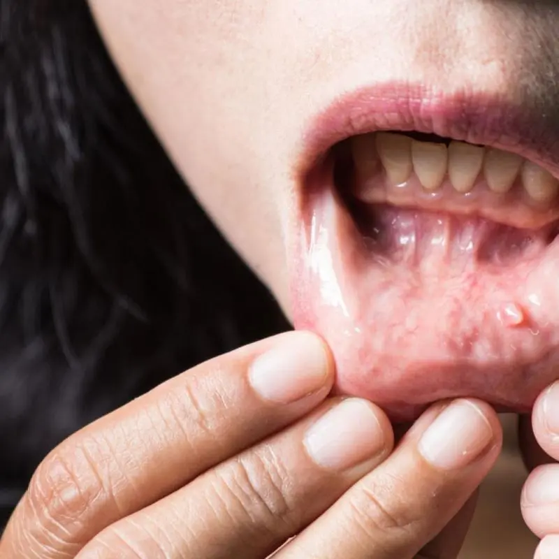 Cómo se curan las verrugas en la boca: Guía completa - Qué pasa cuando te salen verrugas en la boca como se curan las verrugas en la boca - Qué pasa cuando te salen verrugas en la boca
