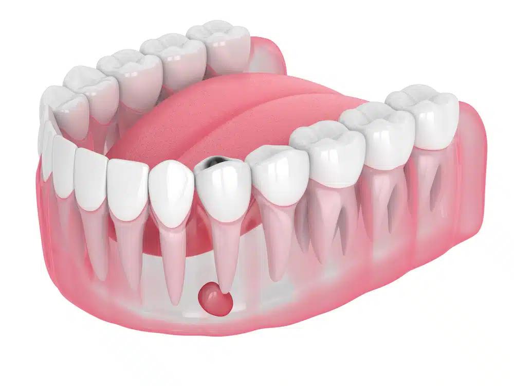 Cómo Quitar un Quiste en la Boca: Guía Completa - Qué pasa si no me quito un quiste dental como quitar un quiste en la boca - Qué pasa si no me quito un quiste dental