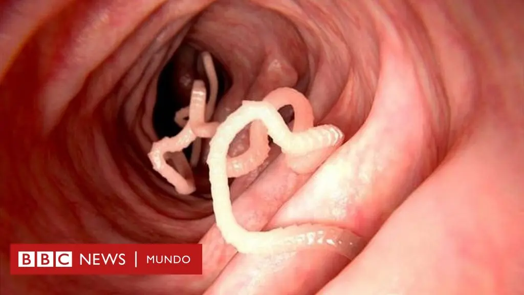 parasitos de la boca - Qué provoca la Entamoeba gingivalis