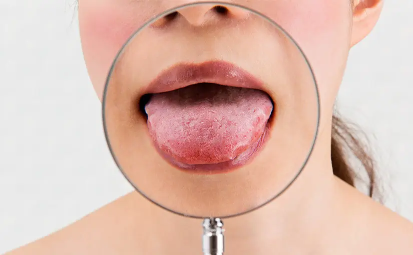 sindrome de boca ardorosa - Qué significa glosodinia