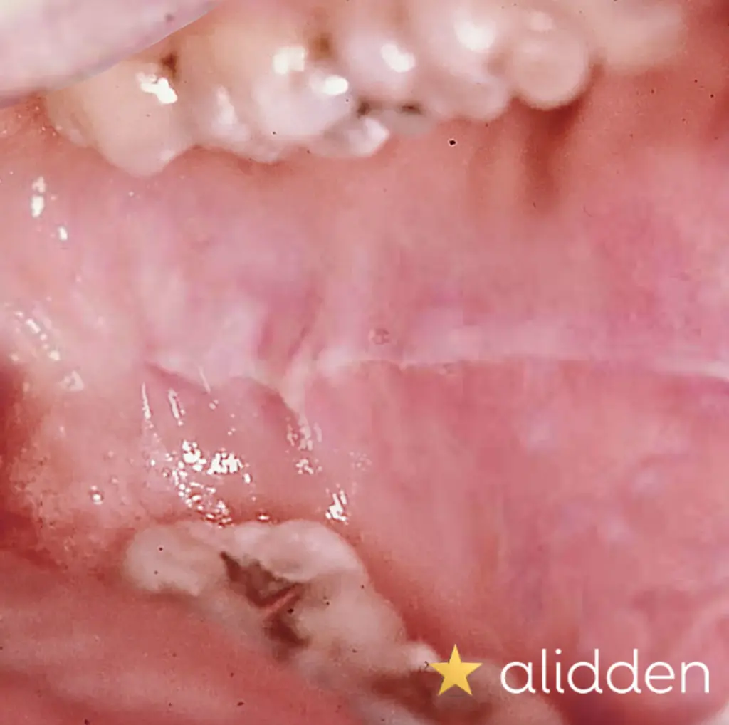 mucosa blanca en la boca - Qué significa mucosa blanquecina