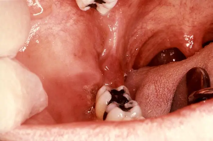 sarcomas en la boca - Qué síntomas provoca el sarcoma