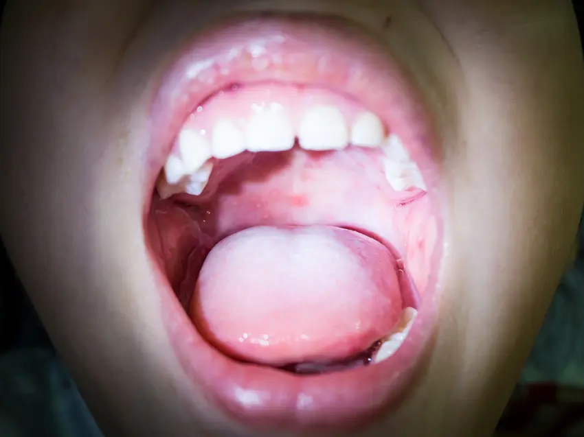 Qué es la Herpangina en la Boca: Causas, Síntomas y Tratamiento - Qué tan peligrosa es la herpangina que es herpangina en la boca - Qué tan peligrosa es la herpangina