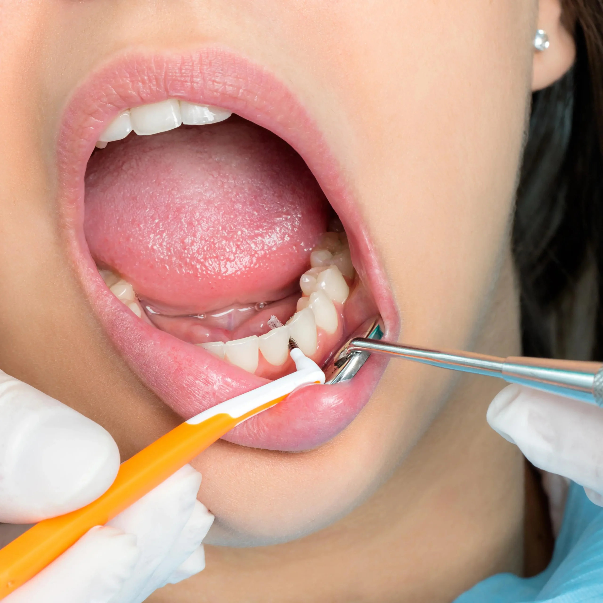 Síntomas del COVID-19 en la Boca: ¿Mito o Realidad? - Qué virus afectan a la boca boca coronavirus - Qué virus afectan a la boca